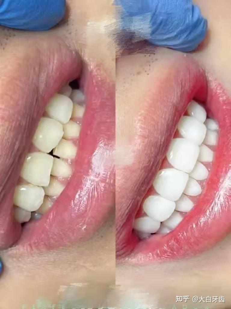 牙贴面选择瓷贴面好还是树脂贴面好?牙齿贴面真的美白吗?