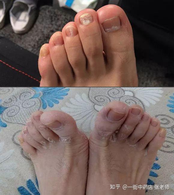 脚气脚臭的尴尬