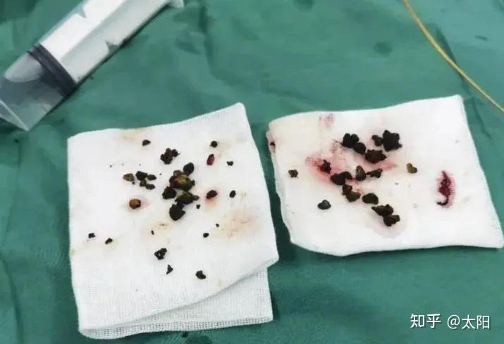 肝内胆管结石严重吗胆囊癌与肝内胆管结石有关系