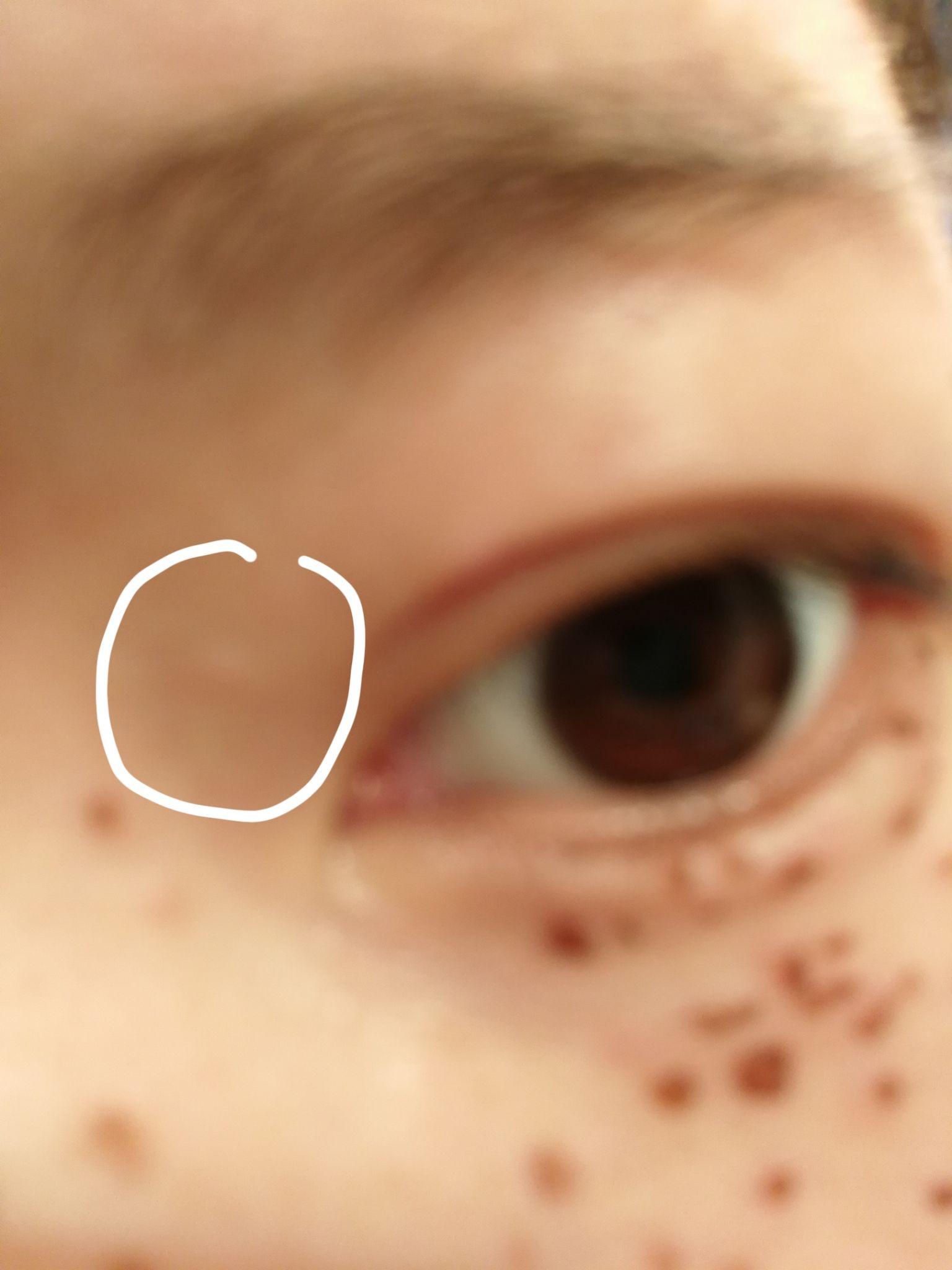 激光治疗了汗管瘤之后痂掉了可是有了小疙瘩还有点发红这个会下去吗