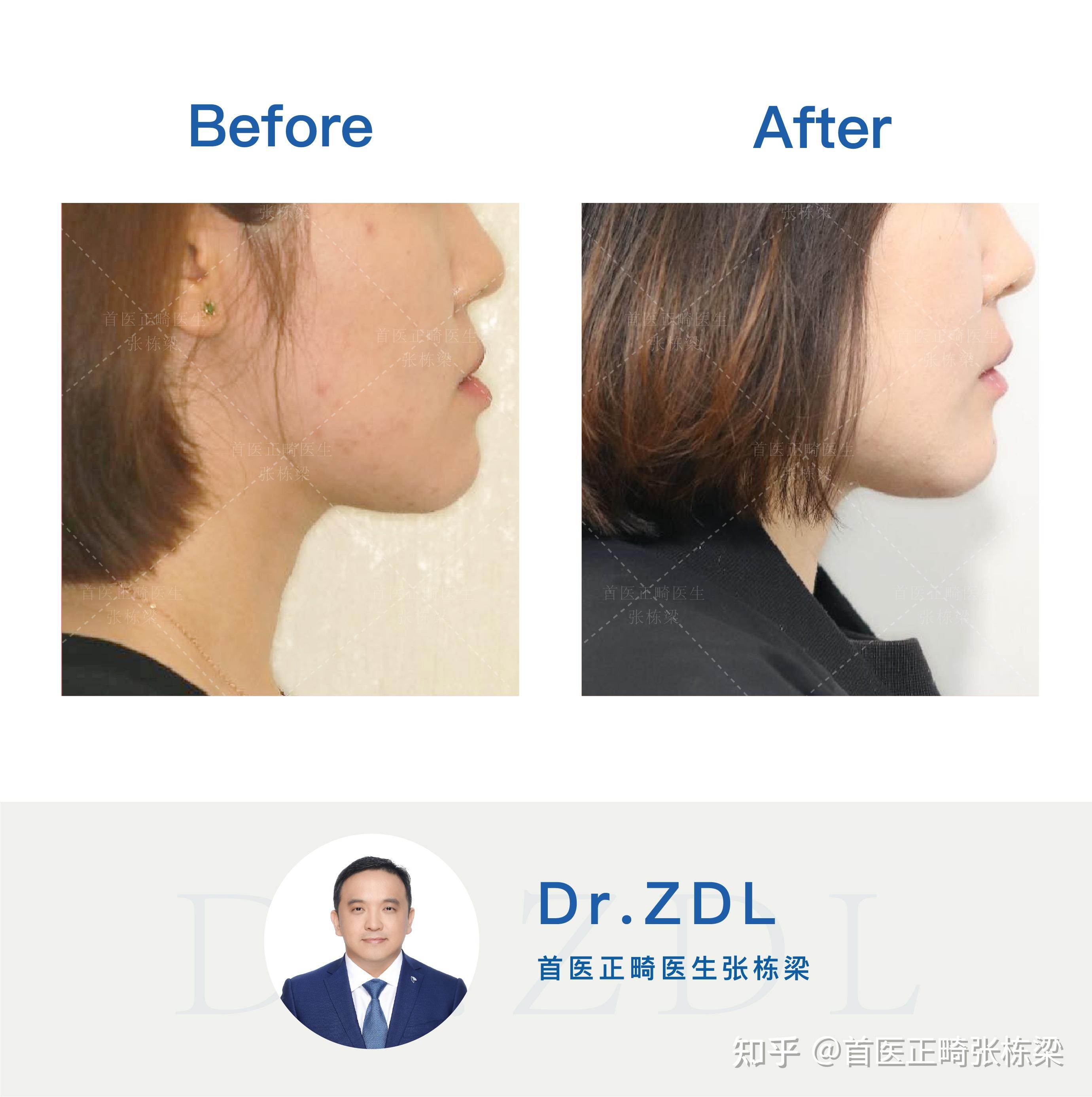 成人正畸改善骨性地包天免受正颌手术痛苦