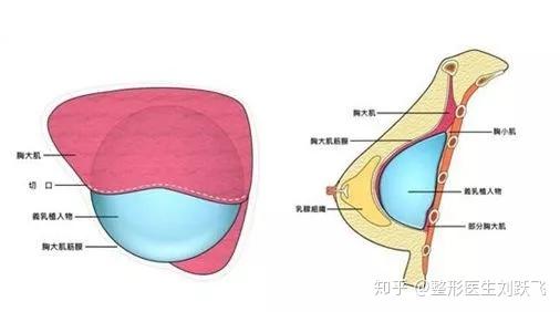 講講隆胸假體植入層面 - 知乎