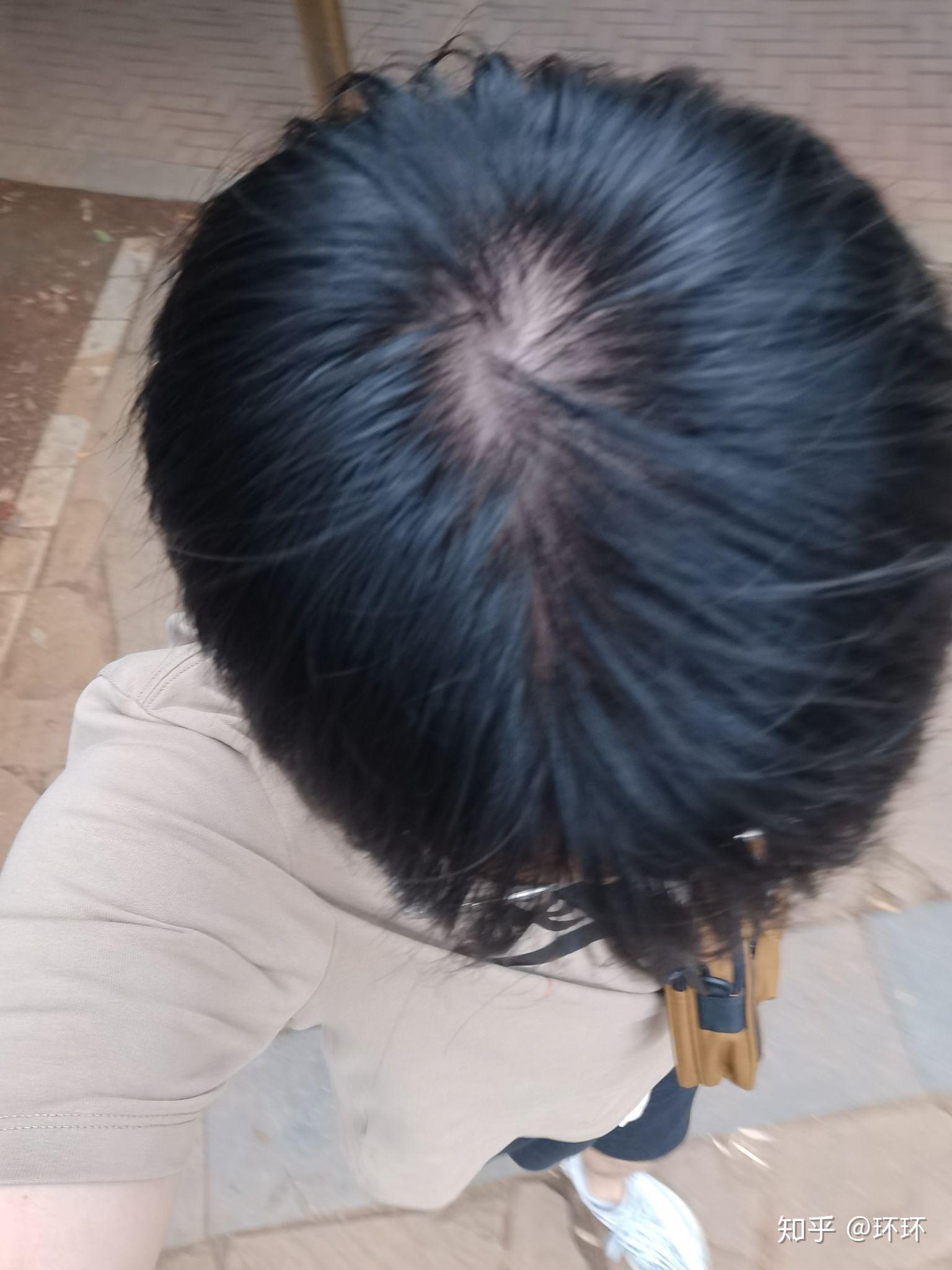 请问各位哥哥们我这算秃顶前兆吗