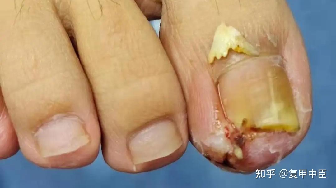 对于真菌性的甲沟炎可以局部使用抗真菌药膏进行治疗,比如可以使用