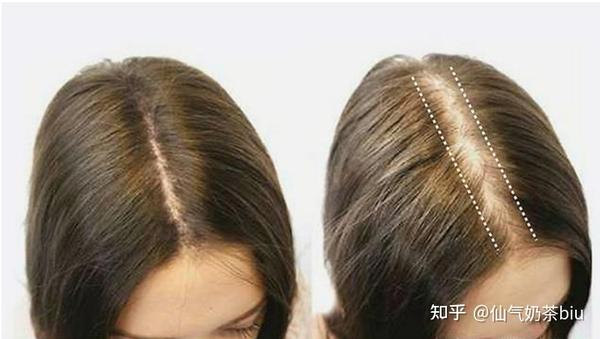 头发掉的多怎么办? - 知乎