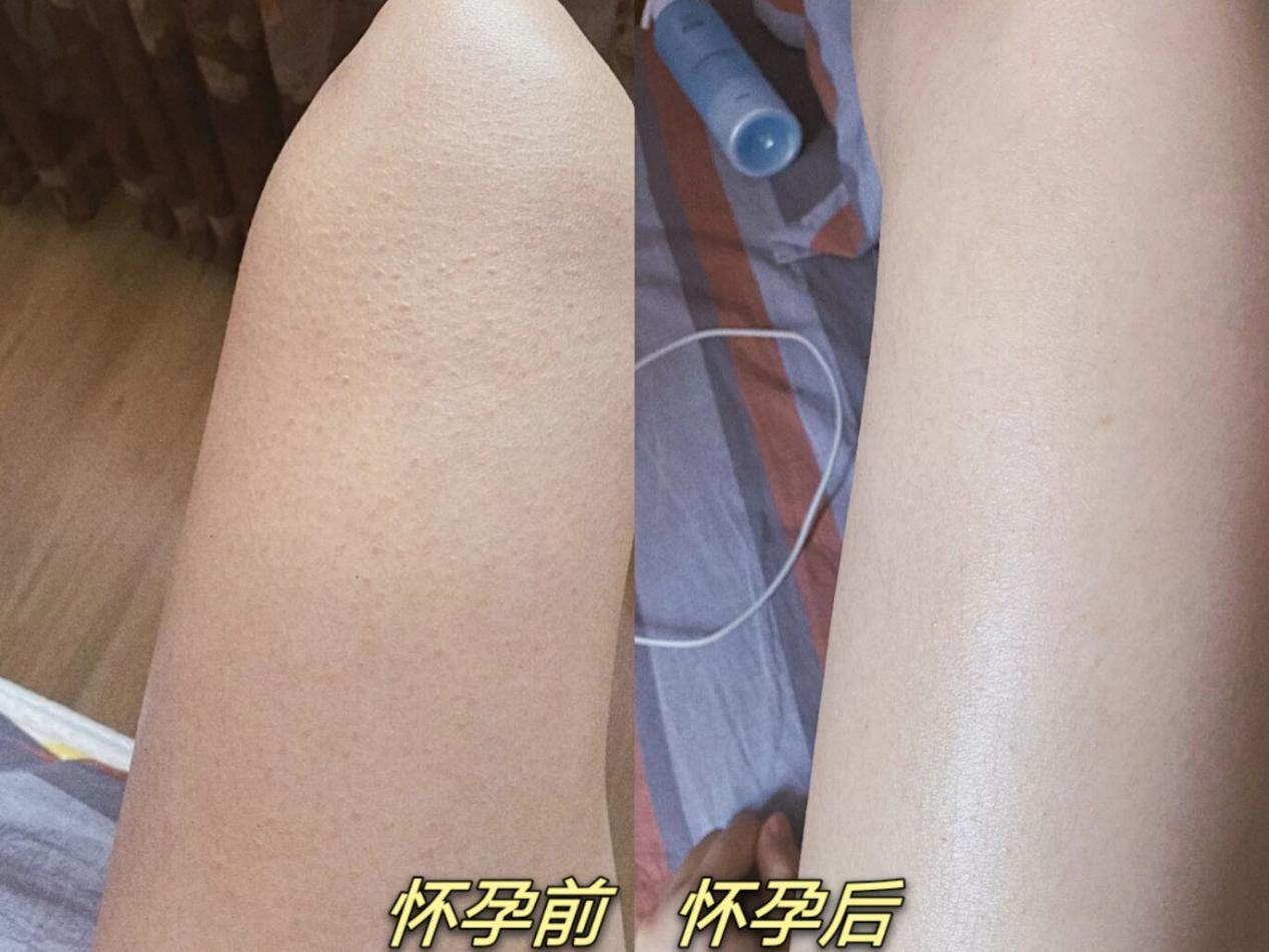 一直涂身体乳会减少妊辰纹(怀孕涂身体乳会减轻妊娠纹吗)