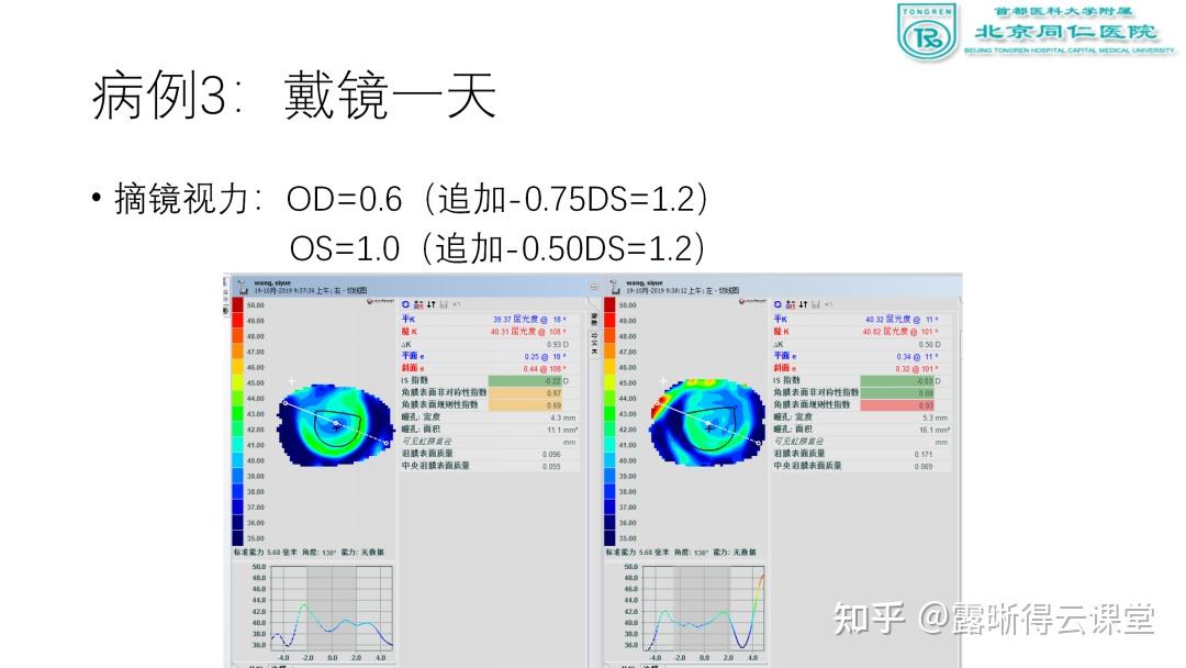 角膜地形图解读及露晰得塑形镜验配要点（文字版） - 知乎
