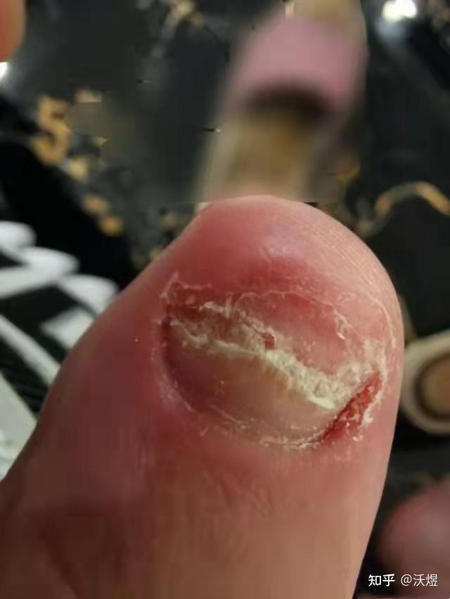 指甲分层断裂是什么原因真的是灰指甲吗