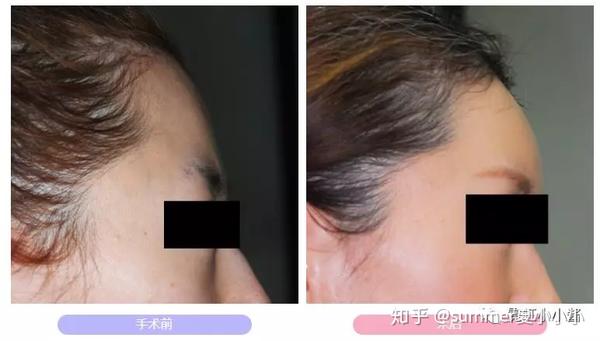 实操案例 禁得起折腾的脸都有个好看又自然眉骨 知乎 实操案例 禁得起折腾的脸都有个好看又自然眉骨 知乎