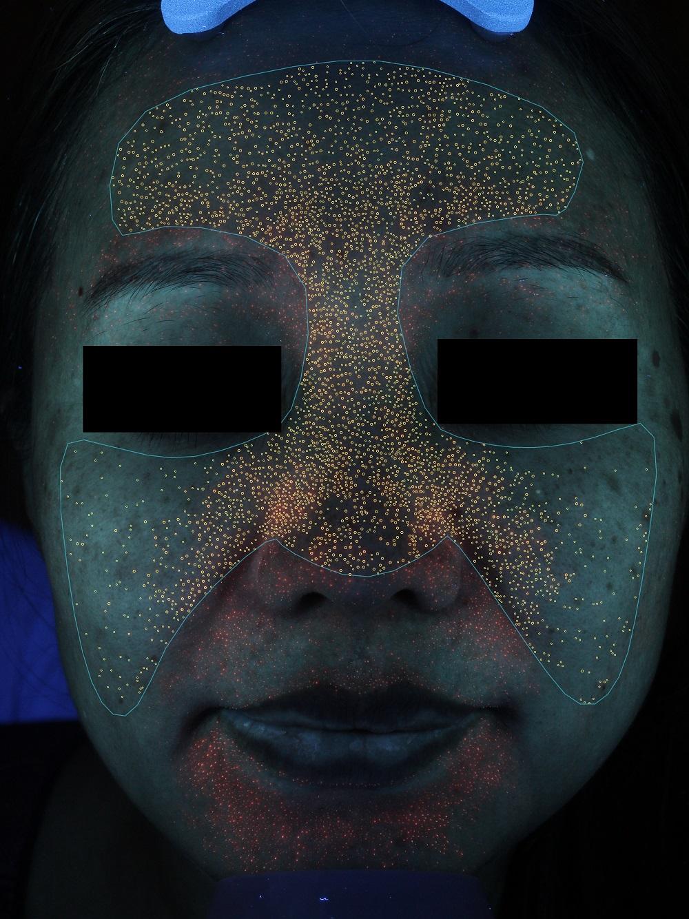 visia镜头下的痤疮丙杆菌 - 没错!你的闭口和痘痘底下都是它