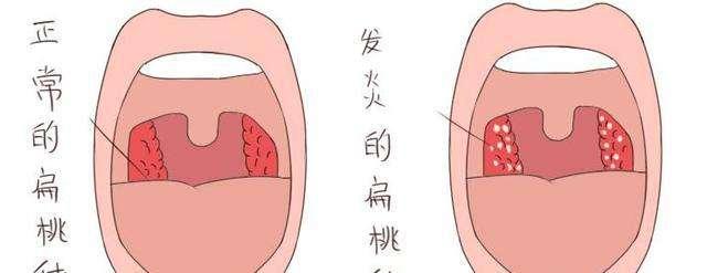 首大石萍 扁桃体炎复发是一个很常见的问题 知乎