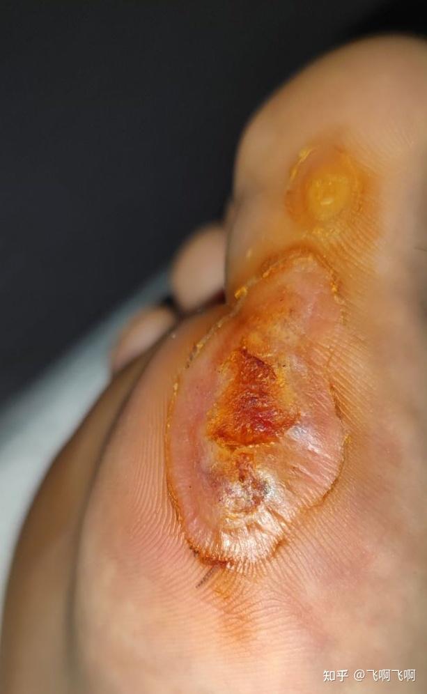 寻常疣拓疣的漫长治疗之路