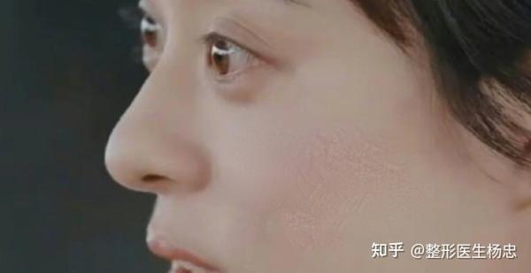 如何才能像赵金麦一样逆袭肿泡眼、凸眼球？ - 知乎