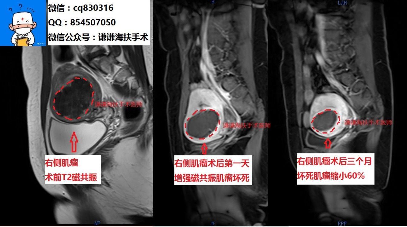 海扶治疗子宫肌瘤随访病历分享 - 知乎