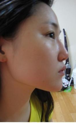 圣形医美案例分享:有图有真相,四方女变成锥子脸的亲身经历