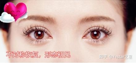埋线双眼皮恢复过程要多久 v2-fb531667aa3e5dd2cbace7e5c0ea083e_r.jpg