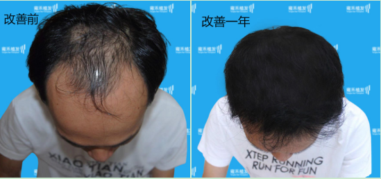 肾虚脱发到底是怎么回事还有救吗如何治疗