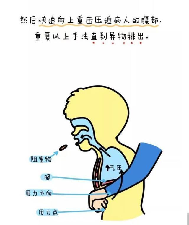 气管异物的急救方法图片