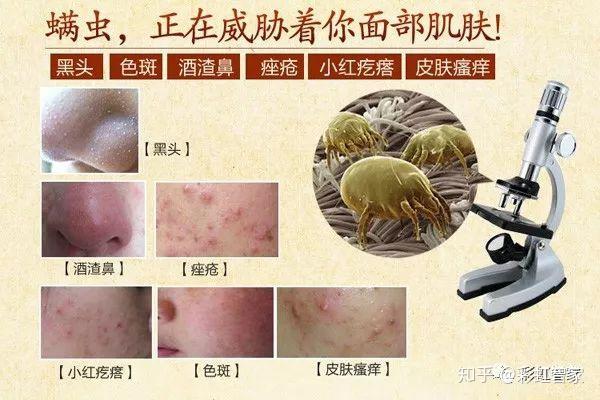 看不见的螨虫看得见的危害