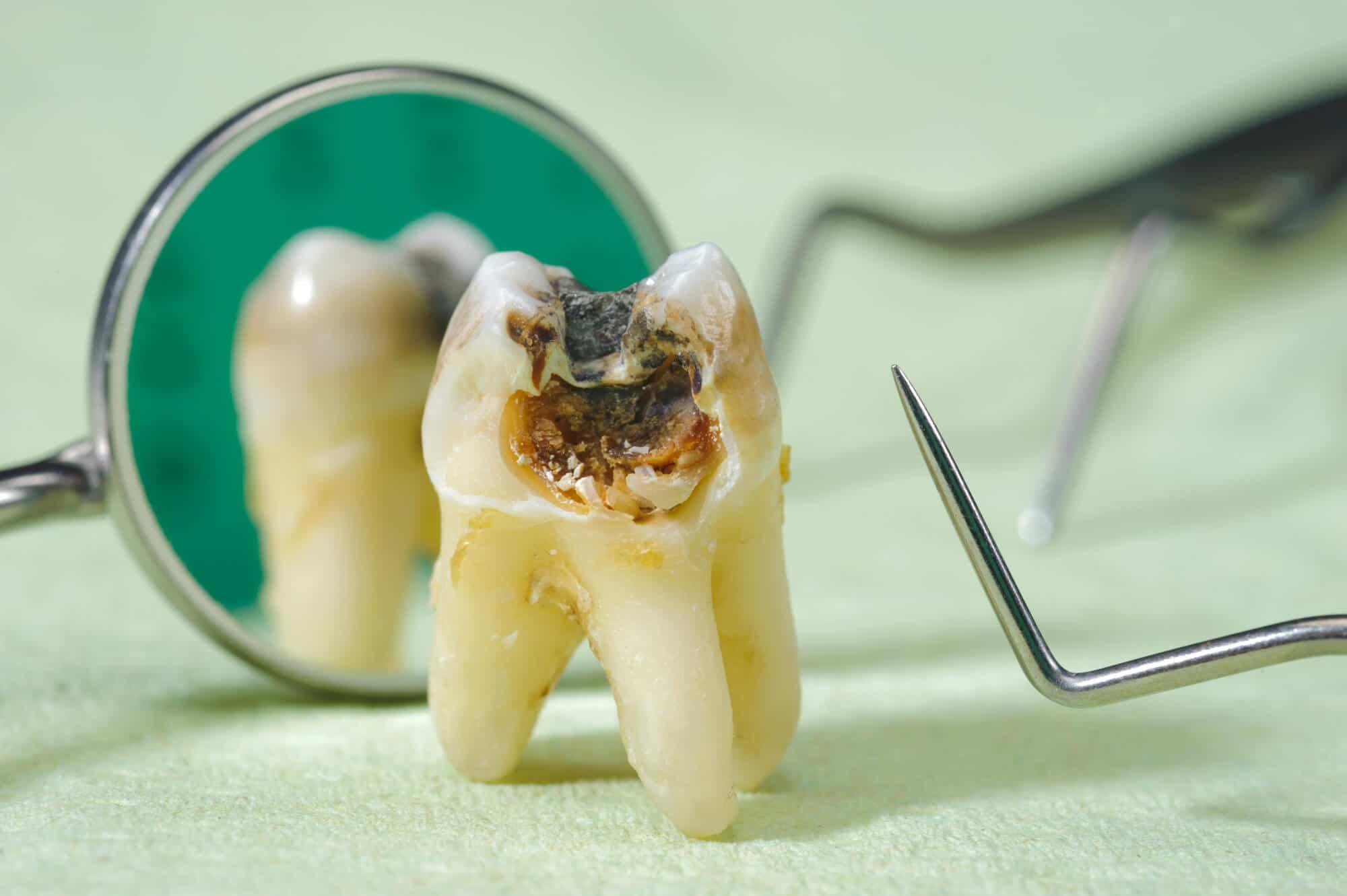 怎么才能有效预防龋齿?