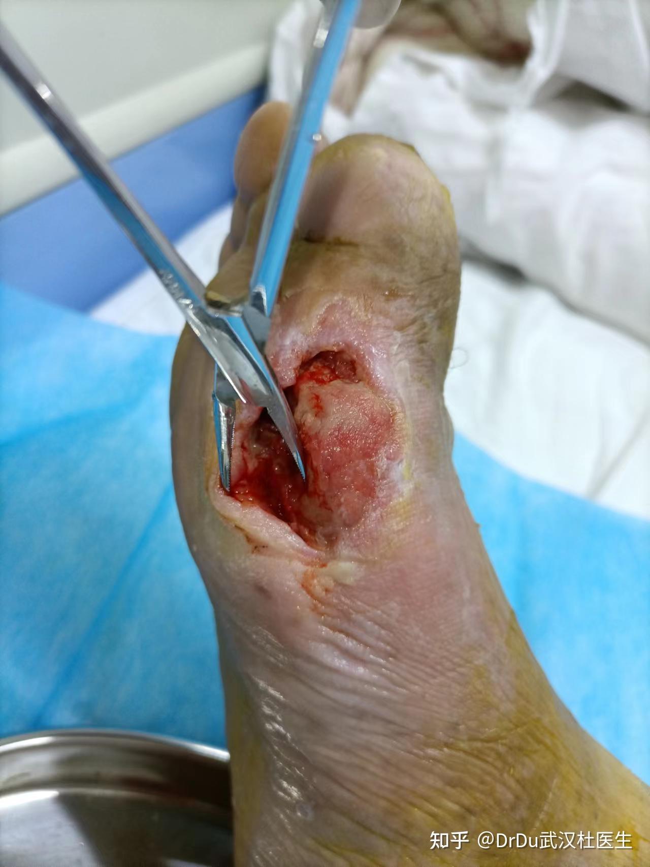记录一位糖尿病足患者的治疗 - 知乎