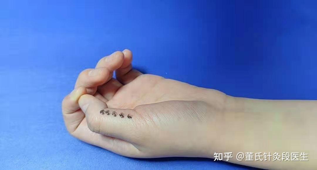 今天分享董氏针灸五虎穴治疗手指脚趾的常用穴位