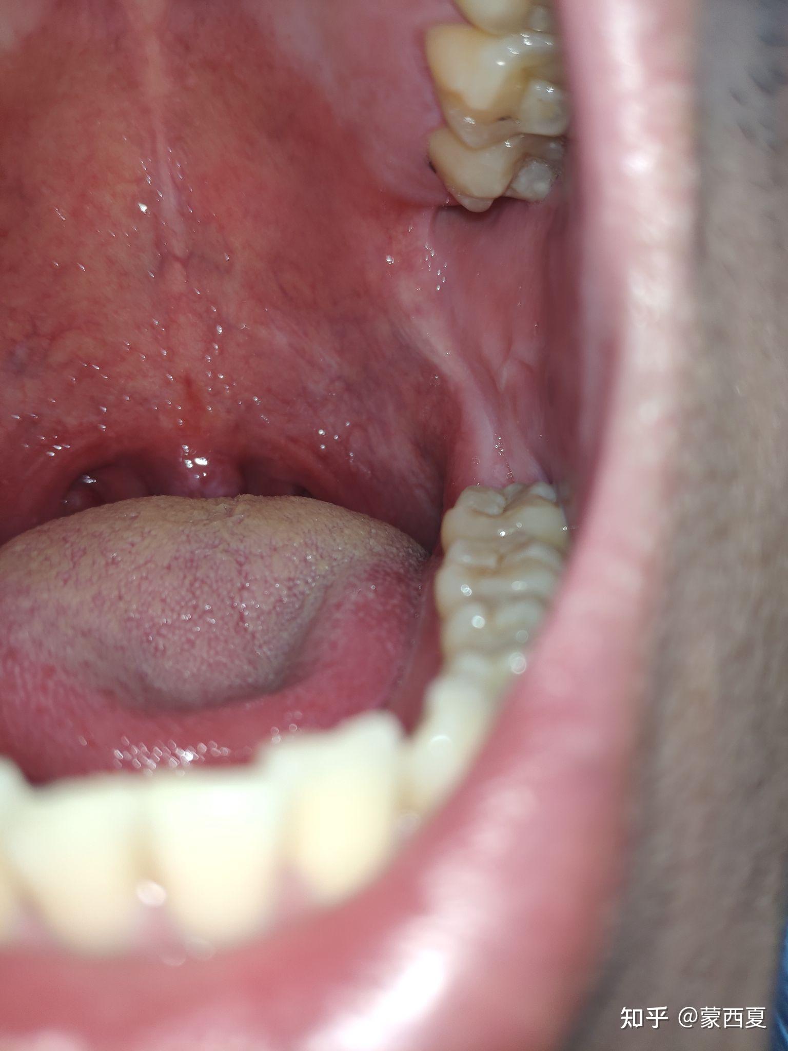 正常悬雍垂图片,正常喉咙小舌头图片(2) - 伤感说说吧