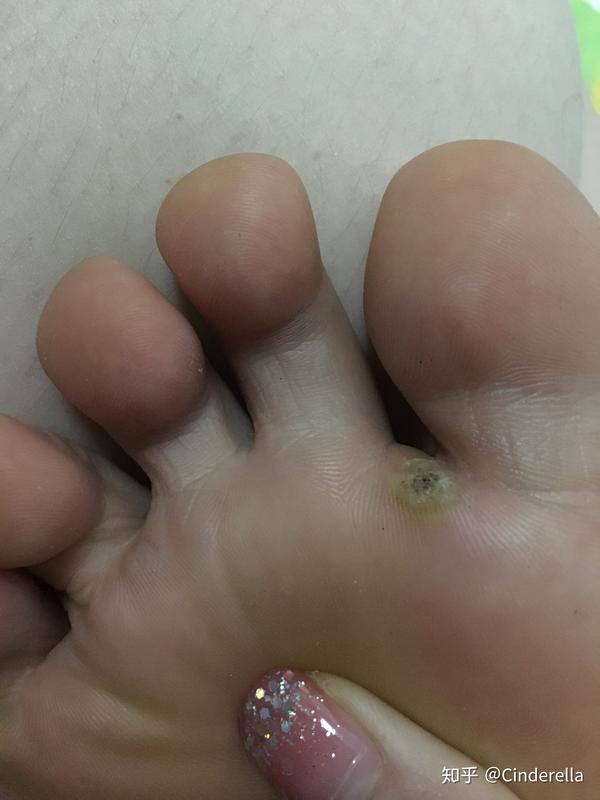 跖疣冷冻跖疣敷大蒜亲测痊愈