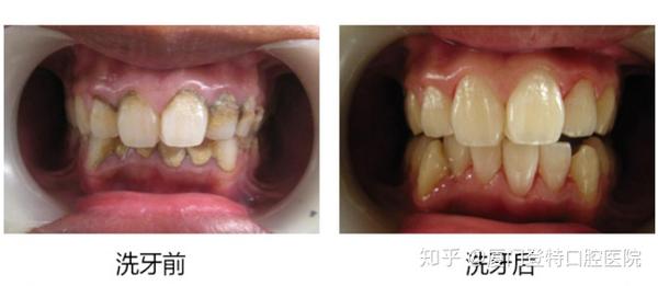 洗牙会伤害牙齿 三张图告诉你真相 知乎