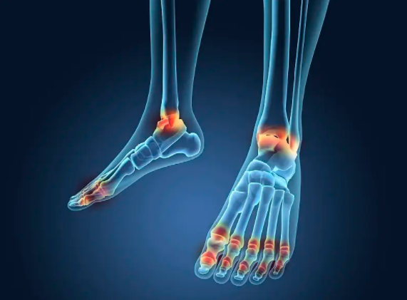 高尿酸血症患者人数高达1.77亿,夏天你还敢啤酒烧烤小龙虾吗?