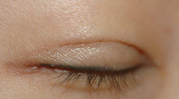 做得好的双眼皮,是睁眼有型闭眼无痕的.