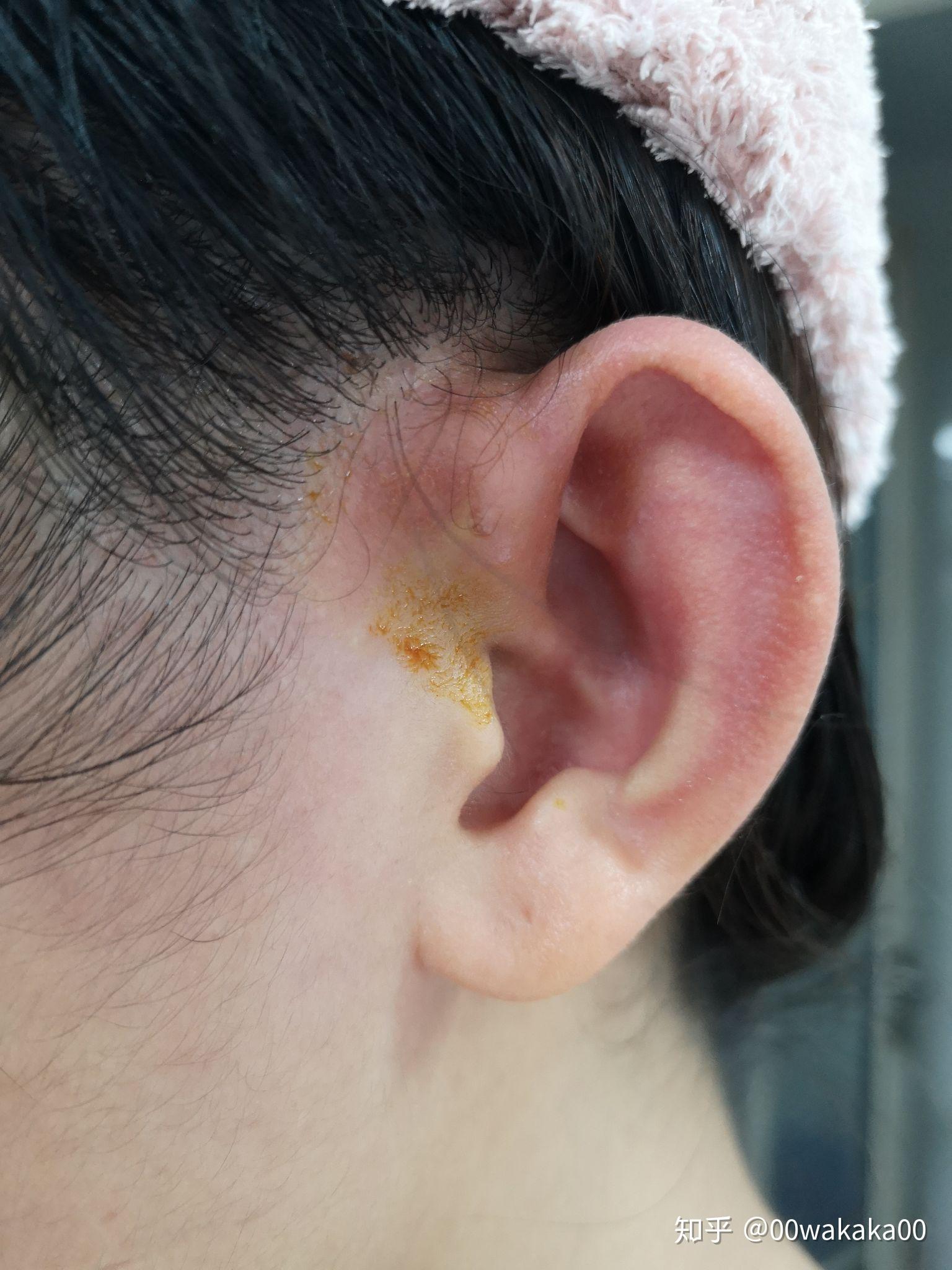 耳前瘘管|耳前瘘管|感染型|超声|脓肿|先天耳畸形|-健康界