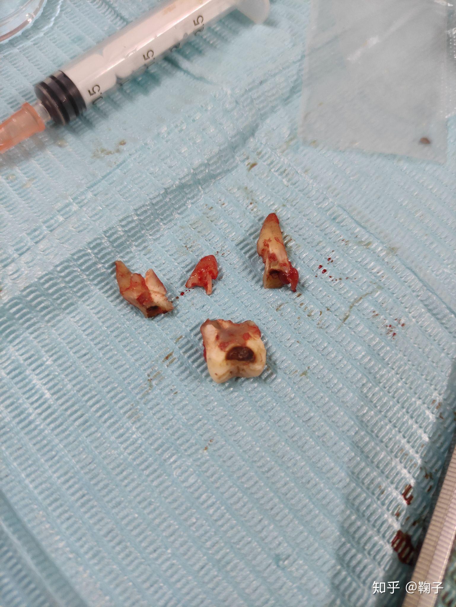 拔了上面第一磨牙,左上牙比右上牙少了两颗天生少了一颗虎牙