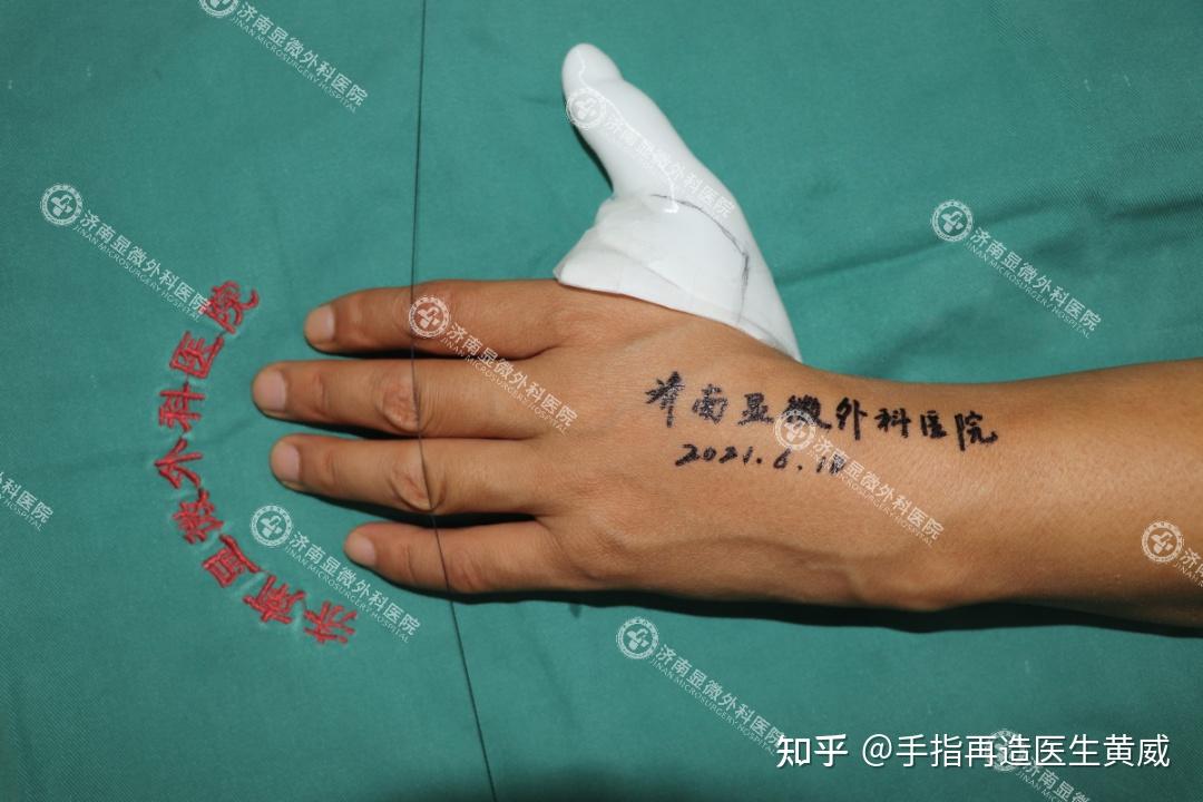 我院成功为先天性拇指缺损合并第一掌骨缺损患者实现手指再造 - 知乎