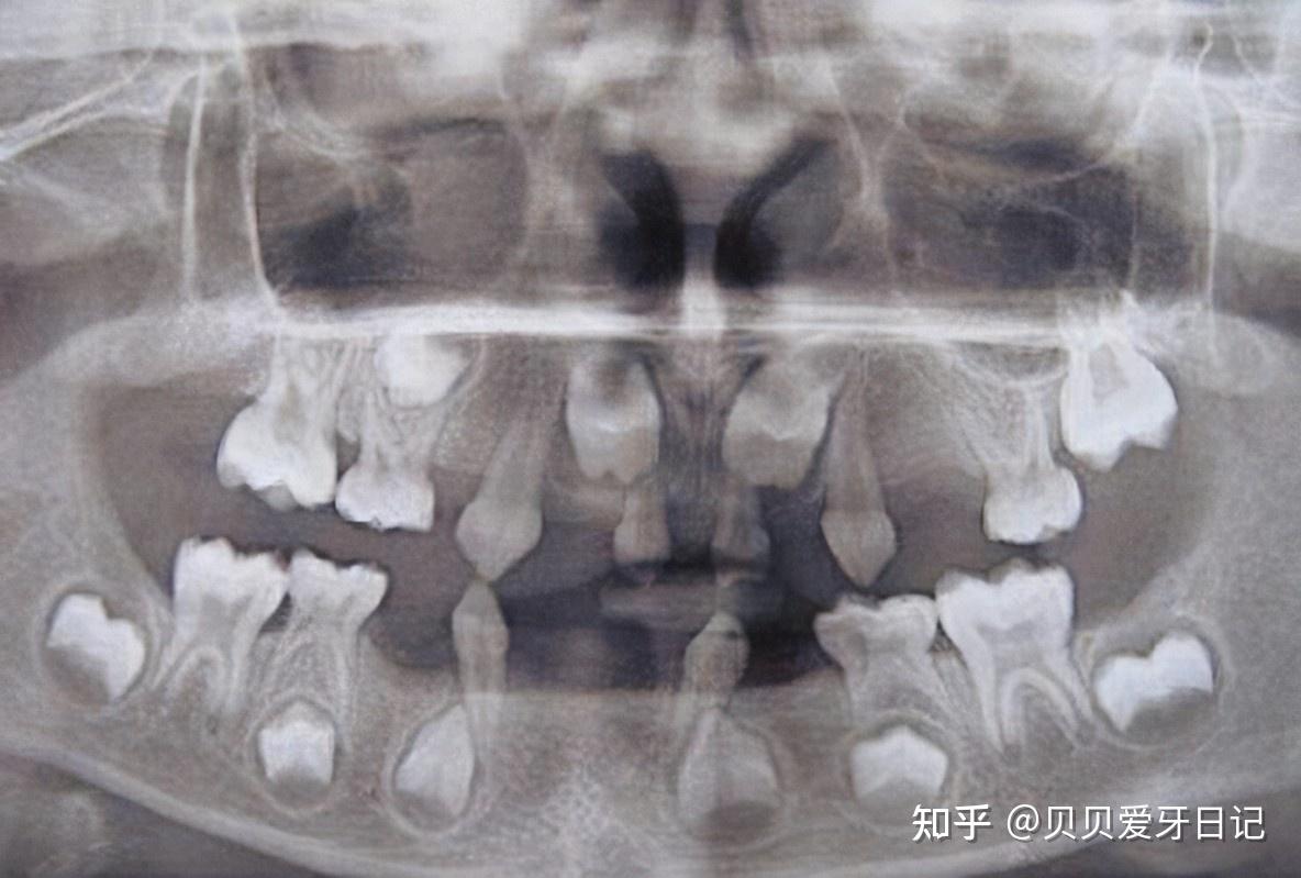 为什么牙齿缺失以后要及时修复 – OMF Surgeon's Notebook