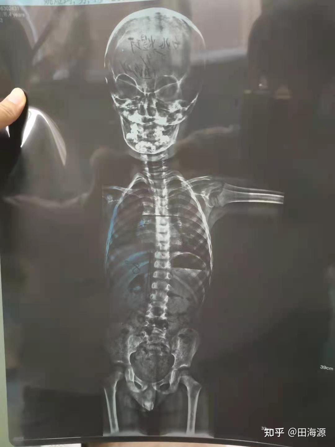 4岁小孩脊柱突出明显图片