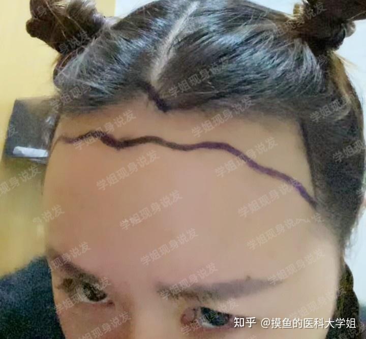 植发签保障书(签约植发协议书范本)