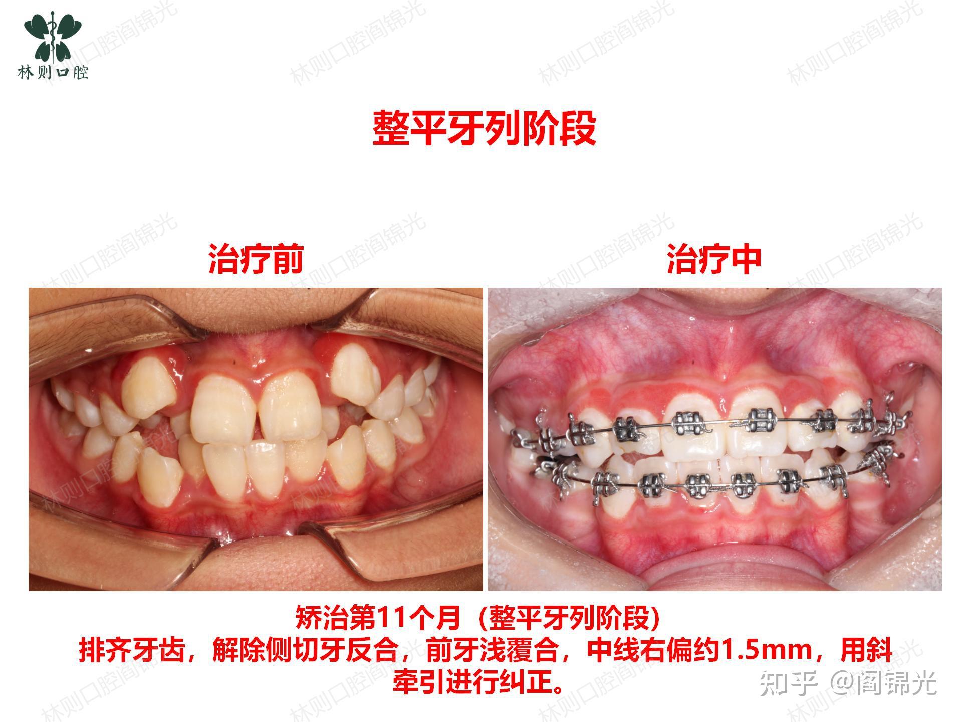 牙齿不齐的发病因素一般为遗传性因素和获得性因素两大类 | 南宁牙齿矫正-南宁众雅口腔