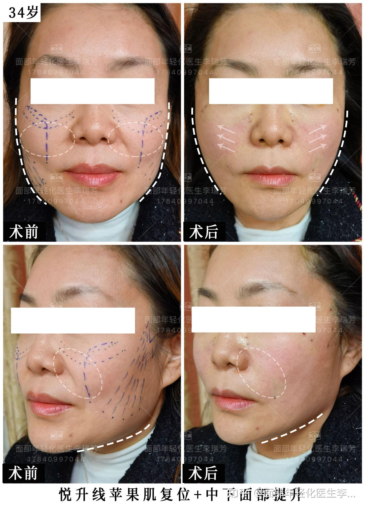 面部年轻化医生李瑞芳悦升线苹果肌复位中下面部提升