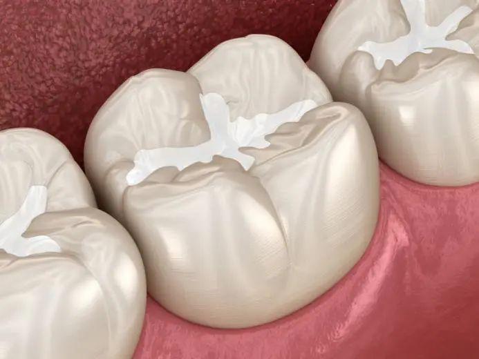 预防蛀牙窝沟封闭有必要最佳年龄是什么时候