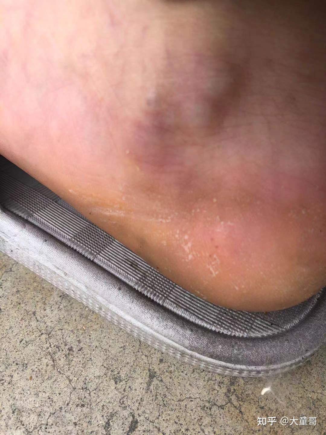 脚踝内侧起了几个疙瘩不疼不痒的?