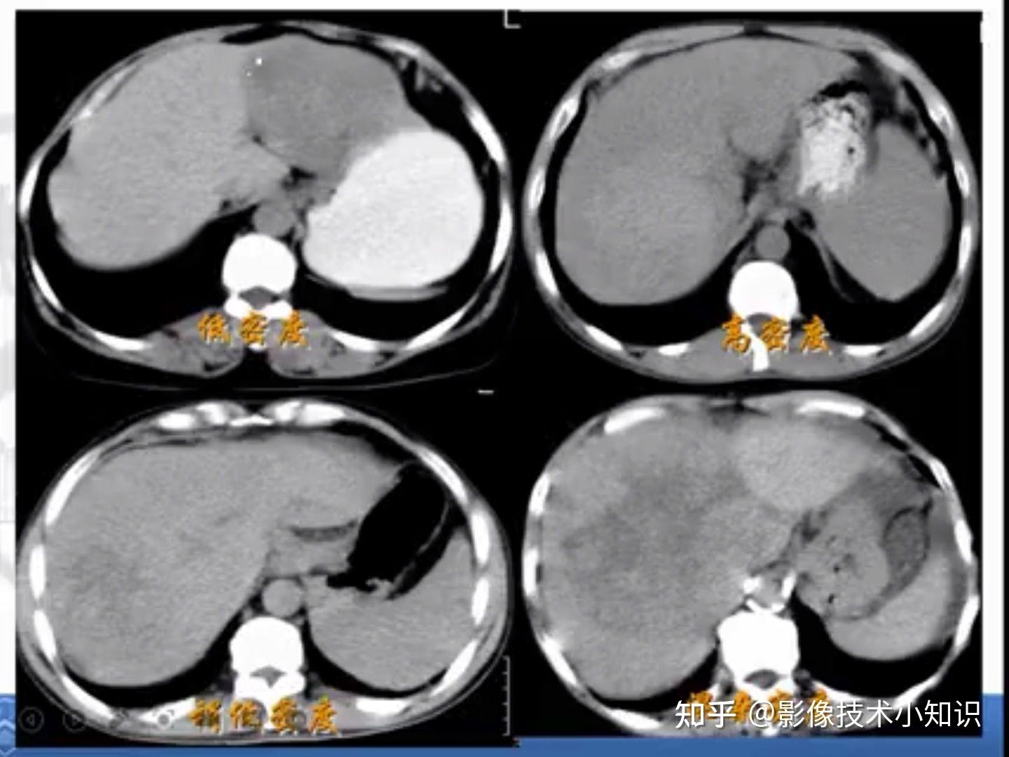 肝癌ct片图片图片