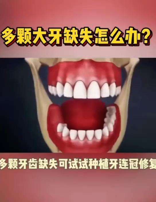 种牙最多可以种几颗 v2-fcd1e4df39d78798085564ea5fc45d62.jpeg