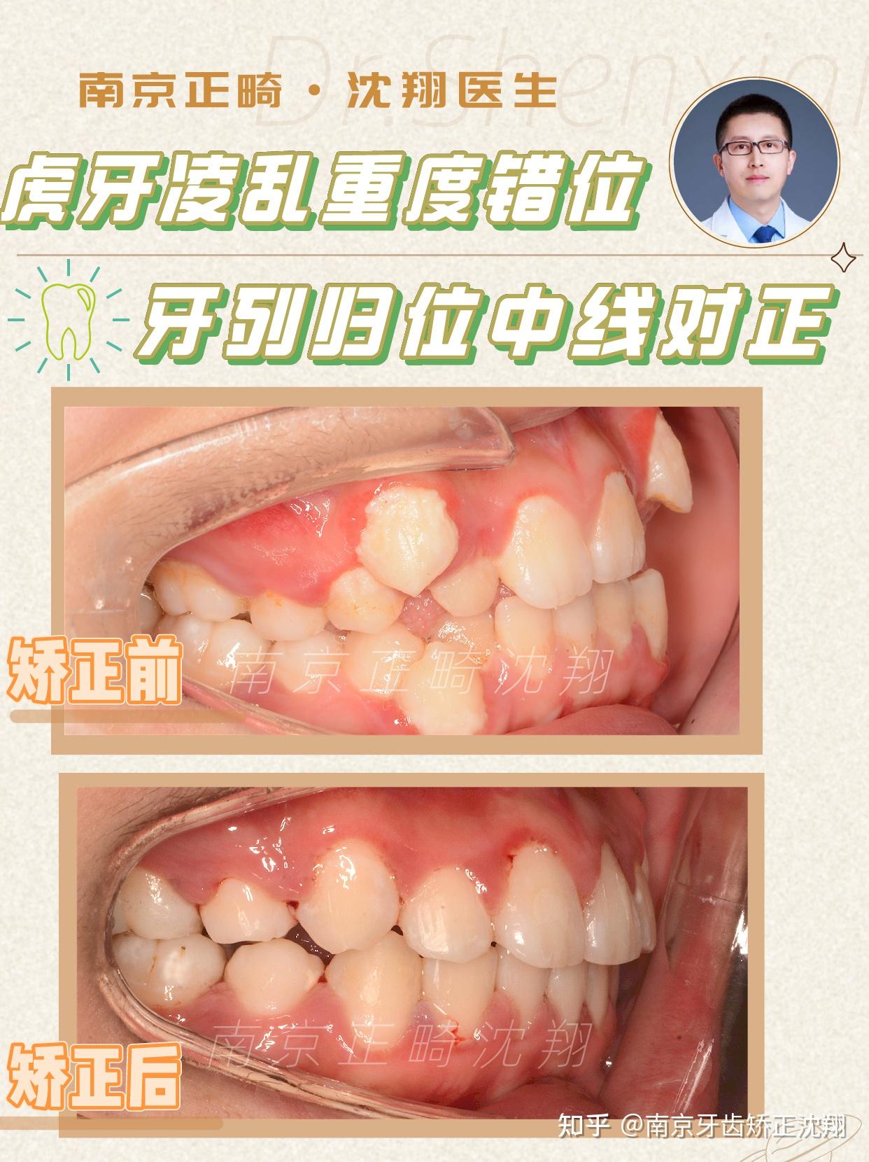 我是沈翔丨帮助5000位正畸患者重获笑容的南京牙齿矫正医生