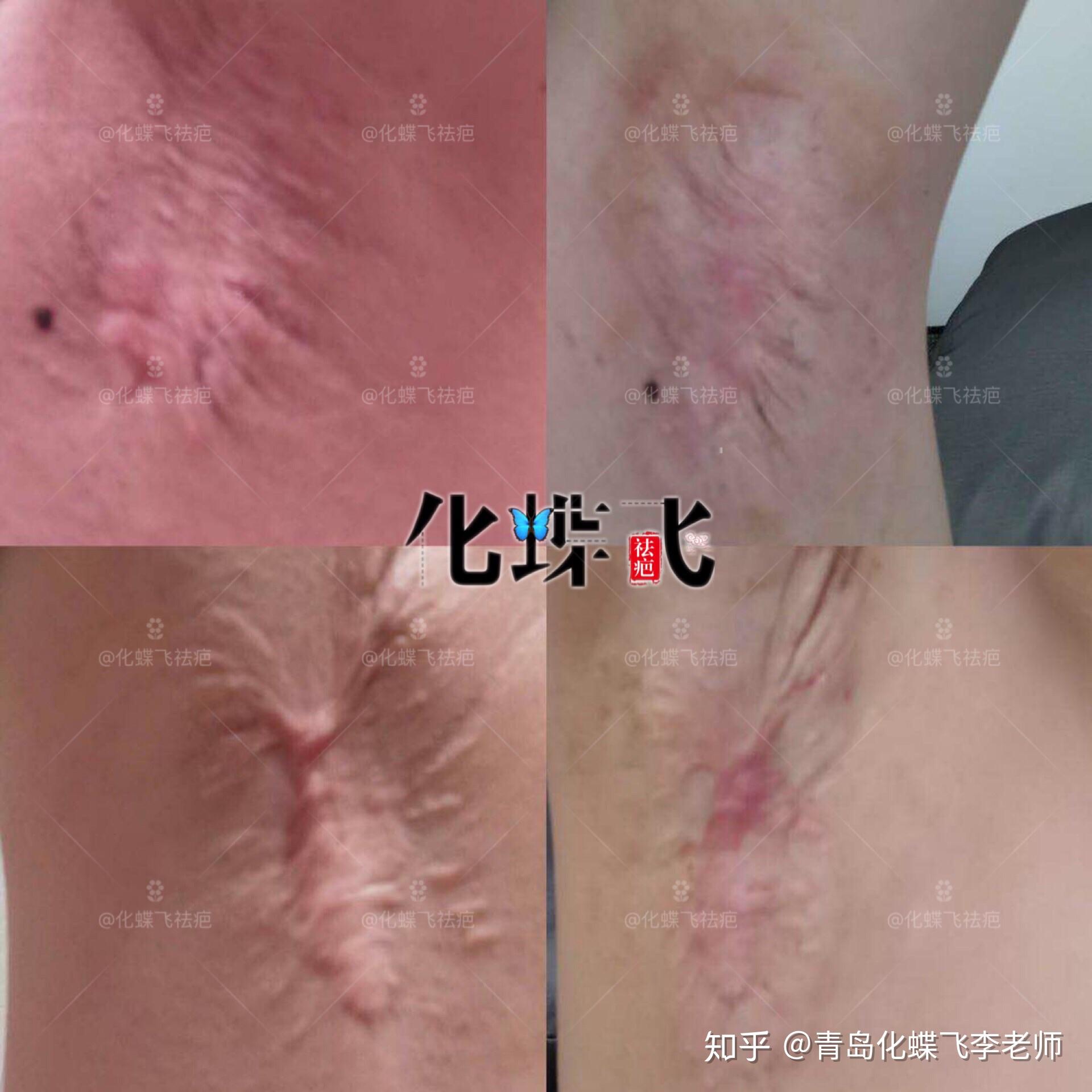 医护人员都在用中药修复腋下手术疤痕,信任和配合很重要 - 知乎