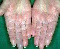 世界硬皮病日q&a——携手同行,走进局限性硬皮病