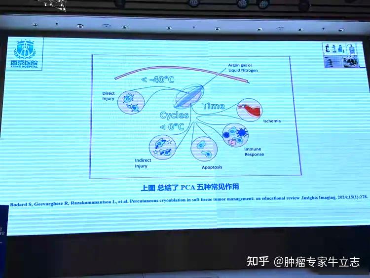 隔山打牛—冷冻消融免疫的“远隔效应”存在吗? - 知乎