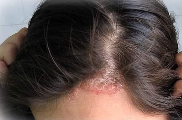 二,皮肤病引起头皮瘙痒皮炎,湿疹,荨麻疹,接触性皮炎,结节性痒疹,皮肤