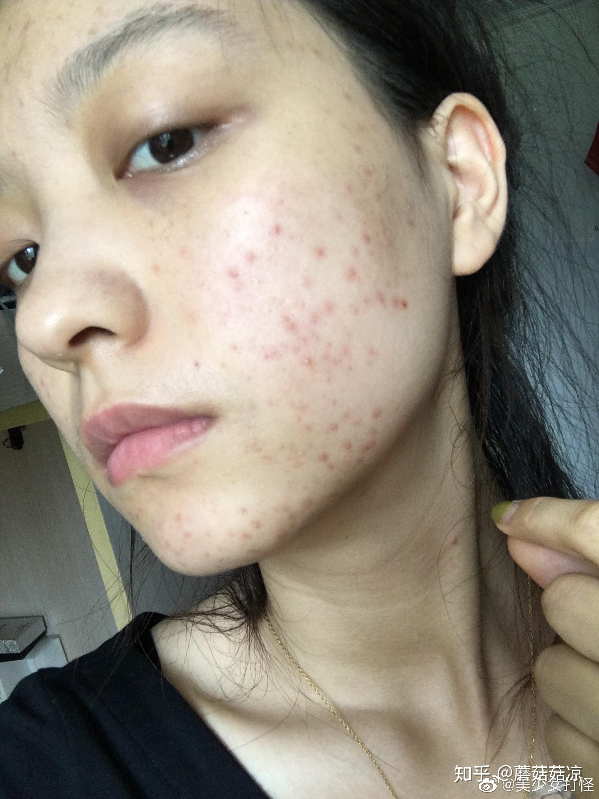 爆痘发胖祛痘减肥女生的两大苦恼我都经历过