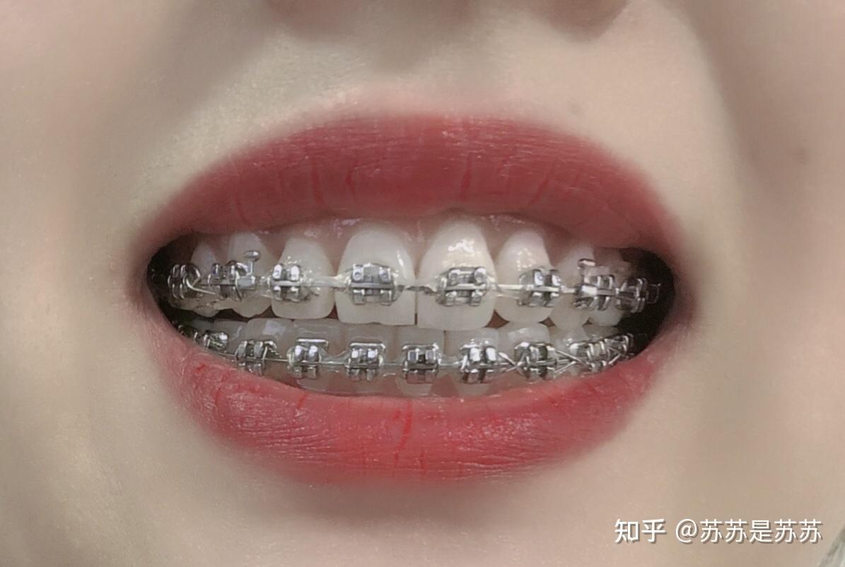 天津医科大学口腔医院牙齿正畸一年更新篇